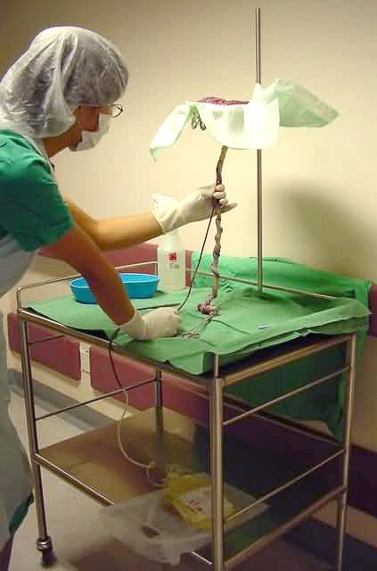 First allogeneic cord blood transplant in Hong Kong